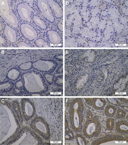 Figure 1 Representative picture of immunohistochemical staining of BTLA and HVEM in gastric tissues.