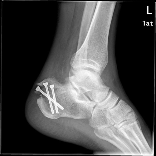 Figure 2 Lateral X-ray of the calcaneus, the avulsion fracture of the calcaneal tuberosity was displaced again, and the internal fixation failed.