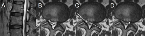 Figure 4 Assessment of lumbar spinal stenosis: (A) antero-posterior diameter (<10mm), (B) cross-sectional area (<70mm2), (C) lateral recess angle < 30°, (D) lateral recess length ≤ 2 mm. (A and B) are central stenosis, (C and D) are lateral stenosis.