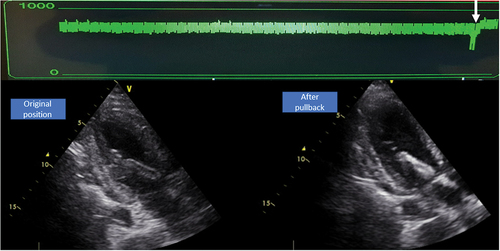 Figure 4. Effect of repositioning on motor current. The pVAD was over-inserted. On pullback you can see an immediate increase in motor current (green) and adequate position on echocardiography.