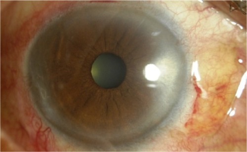 Figure 2 Conjunctival autograft at day 1.