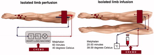Figure 1. Schematic representation of vascular access for ILP and ILI.