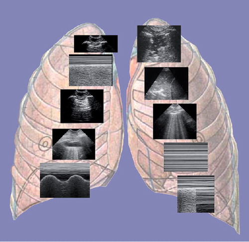 Figure 1. The ten signs of lung ultrasound in the critically ill.This figure shows the alphabet of lung ultrasound in the critically ill. In the right lung on top is the location of the pleural line (bat sign). The bat sign is a sort of G-key, allowing immediate recognition of the lung surface in all circumstances. Just below is the lung sliding (seashore sign in M-mode). Below is an A-line featuring horizontal repetition of the pleural line, a basic sign of air barrier. Below are the quad sign and the sinusoid sign, allowing standardized diagnosis of pleural effusion. In the left lung, on top is the typical shred sign (irregular deep border) indicating lung consolidation. Below is the tissue-like sign, another sign of consolidation. Below is the B-line, a sensitive sign: this is a comet-tail artifact arising from the pleural line, hyperechoic, long, well-defined, erasing A-lines, moving in concert with lung sliding. Several B-lines visible between two ribs are called lung rockets. See their practical relevance in the text. Below is the stratosphere sign, demonstrating abolition of lung sliding. The last image is the lung point, a sign specific to pneumothorax (the lung point corresponds to the cyclic and sudden visualization of lung signs when the collapsed lung touches the chest wall on inspiration).Reprinted from Citation[5] with permission from Springer Science+Business Media.