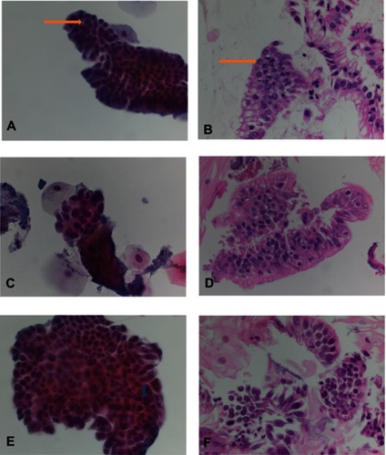 Figure 3 Atypical glandular cells (AGC), suspicious for esophageal adenocarcinoma (SFEAC) and esophageal adenocarcinoma (EAC). (A and B) AGC: The specimen consists of a sheet of glandular cells with increased nuclear size and prominent nucleoli (see arrow). (C and D) SFEAC: The specimen consists of rare cluster of glandular cells with high nuclei/cytoplasm ration, irregular nuclear contour, prominent nucleoli, hyperchromasia and overlapping. (E and F) EAC: The specimen consists of multiple clusters of glandular cells with high nuclei/cytoplasm ration, prominent nucleoli, irregular nuclear contour, hyperchromasia, mitosis (see arrowhead), overlapping and the single cells.