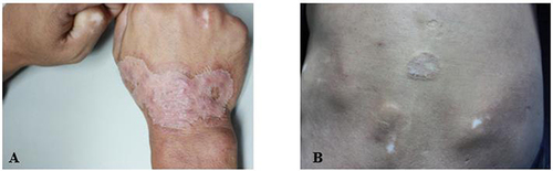 Figure 6 Patient No.4 (A) Image of Trichophyton rubrum infection on the right-hand (B) Image of Trichophyton rubrum infection on the back.