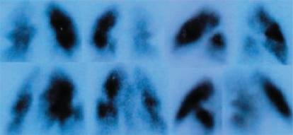 Figure 1 Perfusion scintigraphy pre-thrombolysis.