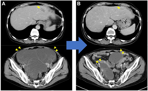 Figure 2 CT scan in case 1. (A) Before the start of nivolumab plus SOX. (B) After the third course of nivolumab plus SOX. Explanations: Arrows in upper pictures show liver metastasis; Arrows in lower pictures show bilateral ovarian metastasis.