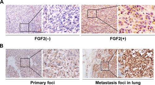 Figure 1 FGF2 expression in human uveal melanoma tissue samples. (A) Representative images of negative FGF2 expression in a spindle cell subtype sample and positive FGF2 expression in an epithelioid subtype sample (immunohistochemical staining, 100×); (B) FGF2 expression was higher in lung metastatic foci than in the primary foci from the same patient (immunohistochemical staining, 100×).