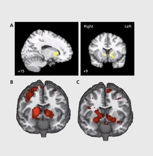 Figure 1 Ventral striatal dysfunction in unmedicated schizophrenia patients. (A) Reduced ventral striatal activation during reward anticipation using the monetary incentive delay (MID) task as reported by Juckel et al.Citation26 (B) Coding of reward prediction errors in ventral striatal activation during reversal learning in healthy controls. (C) Reduced coding of reward prediction errors in ventral striatal activation in unmedicated schizophrenia patients compared with healthy controls. A is reproduced from ref 26: Juckel G, Schlagenhauf F, Koslowski M, et al. Dysfunction of ventral striatal reward prediction in schizophrenia . Neuroimage. 2006;29(2):409-416. Copyright ©Elsevier Inc. 2005. B and C are reproduced from ref 52: Schlagenhauf F, Huys QJ, Deserno L, et al. Striatal dysfunction during reversal learning in unmedicated schizophrenia patients. Neuroimage. 2014;89:171-180. (No permission required as this article is available under the terms of the Creative Commons Attribution License.)