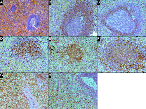 Figure 2 Histologic and immunophenotypic findings in the spleen involved leukemic non-nodal mantle cell lymphoma and T-cell large granular lymphocytic leukemia. (A) Follicle with a germinal center and unexpanded mantle zone, a cluster of small lymphoid cells, and moderate expansion of splenic cords by small lymphoid cells (H&E, x100). (B) CD5 immunohistochemical staining shows a brightly positive signal in reactive T-lymphocytes and weakly colored mantle zone cells (CD5 stain, x200). (C) Cyclin D1 expression in the nuclei of cells, mostly in the inner mantle zone (cyclin D1 stain, x200). (D) Small cluster of cyclin D1-positive lymphocytes in the red pulp (cyclin D1 stain, x400). (E and F) Lymphocytes in the small cluster express BCL2 (E, BCL2 stain, x400) and weakly express CD5 (brightly colored cells are reactive T-lymphocytes) (F, CD5 stain, x400). (G and H) Neoplastic T cells in the splenic cords express CD3 (G, CD3 stain, x100) and granzyme B (H, granzyme B stain, x200).