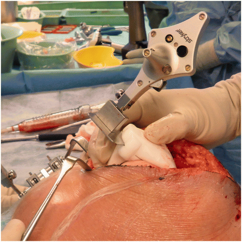Figure 1. Technique used to measure femoral cutting guide position and orientation using the navigation system.