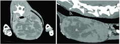 Figure 1. Transverse and sagittal CT images of a cervical thymoma. ( a) Thymoma. (b) Cervical trachea.