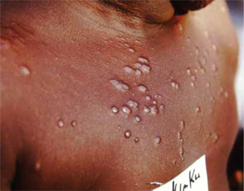 Figure 3 Nodular papular post kala-azar dermal leishmaniasis.