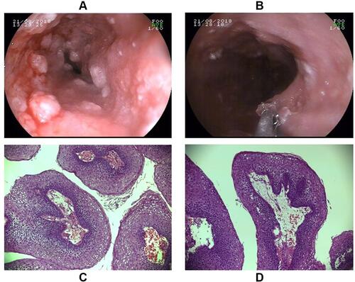 Figure 3 Gastroscopy revealing multiple esophageal eminences (A and B), and the pathological findings of esophageal hyperplasia (C and D) which were consistent with AN (HE stain ×100).