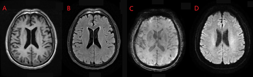 Figure 1 MRI of the brain: (A and B) Are MRT1 and T2 FLAIR of the brain, (C) is MRSWI of the brain, and (D) Is MRDWI of the brain. Multiple patchy long T1 and long T2 signal foci are observed in the bilateral Corona radiata and frontal lobes, with high signal in the periventricular space and no evident high signal in DWI. The ventricular system is dilated, and the cerebral sulci and fissures show no significant widening or deepening. The midline structures are centered. Honeycomb-like long T1 and long T2 signal are observed in the bilateral mastoid cells. On SWI, a small round low signal is seen in the left frontal lobe; no significant abnormal high signal is observed in DWI.