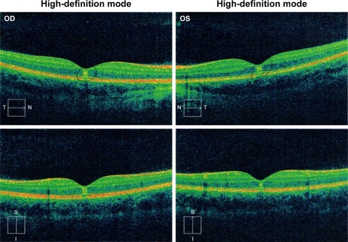 Figure 1 Time-domain optical coherence tomography (Cirrus™, Carl Zeiss Meditec) findings from Case 1.