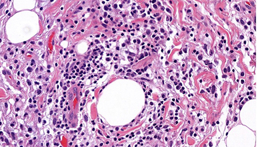 Figure 7 H&E (40×) The light microscopic picture of tenon capsule shows high-power field findings of lymphoid aggregate which is composed of polymorphic lymphoid cells and plasma cells, without definite evidence of granuloma and vasculitis.