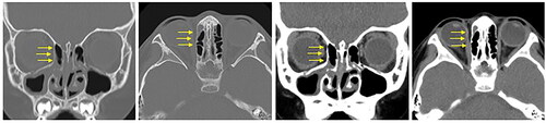 Figure 3. Sinus CT images (coronal and axial views) obtained 6 months after discharge. Regeneration of the right medial orbital wall is clearly visualized (arrow). CT: computed tomography.
