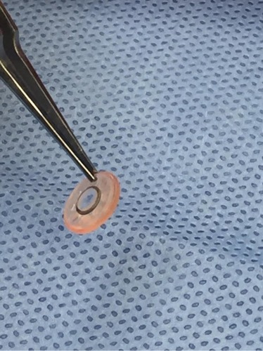 Figure 4 Intraoperative photo of assembled keratoprosthesis prior to implantation, including optic, trephinated corneal graft, and back plate.