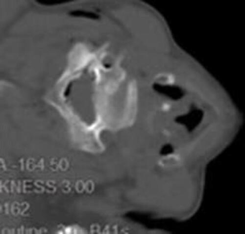 Figure 6 These was injected followed by ozone (40ug/mL) for 3mL each segments, this picture showed ozone spread in the epidural space and around the artery.