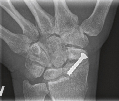 Figure 4. Scaphoid fracture operated with a screw. Non-union and misplaced screw causing destruction the radio-scaphoid joint.