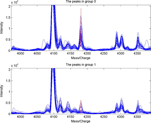 Figure 1.  Protein mass peak 4181 expressed significantly high in the serum of healthy individuals, while serum of OSCC patients presented a remarkably low protein mass peak at 4181 (P=0.0000000060).