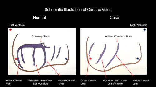 Figure 2. Schematic illustration of cardiac veins in a normal heart (left) and as observed in the case (right).