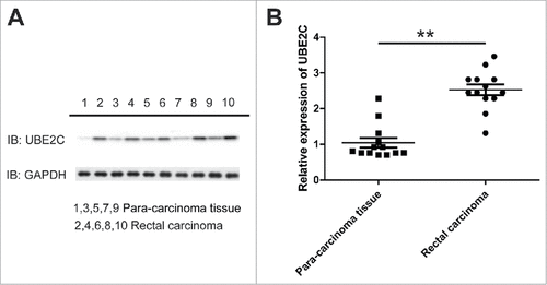 Figure 1. UBE2C up-regulated in rectal carcinoma. A) Western bolt showed protein levels of UBE2C in 5 rectal carcinomas compare to their para-carcinoma tissues. B) Q-PCR showed the expression level of UBE2C in another 13 rectal carcinoma tissue samples. ## indicated p<0.01.