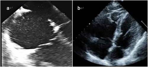 Figure 8. Partial echocardiographic analysis of patients. (A was a sample of a 25-year-old male patient; B was a sample of a 40-year-old female patient).