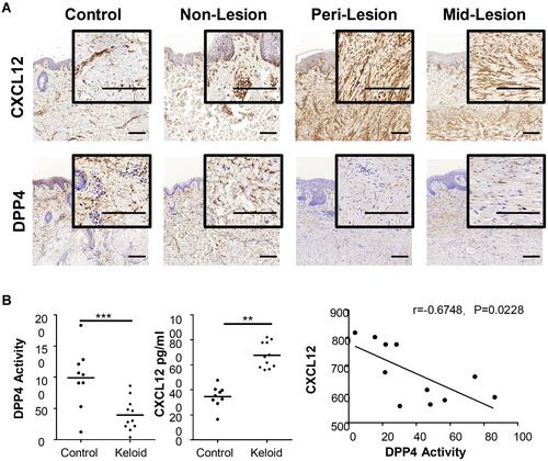 Figure 1 Expression of CXCL12 and DPP4 in keloids and mature scars. (A) Immunohistochemical staining of CXCL12 and DPP4 in mature scar tissue (n=11) and various sites of keloid scarring (n=12). Bars=200μm. (B) Quantification of DPP4 activity (microunit/mL) and CXCL12 (pg/mL) in tissue homogenates from healthy subjects (n=9) and keloid patients (n=11). Correlation analysis of DPP4 activity and CXCL12 was performed for each group. **P < 0.01, ***P < 0.001.