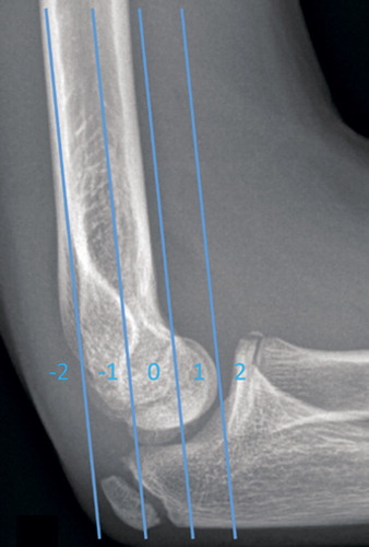 Figure 3. The intersection point of the anterior humeral line with the ossification center of capitellum divided into 5 different zones.