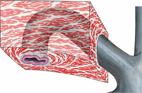 Figure 1. Schematic illustration of the Horner-Duverney’s muscle: Note the criss-cross pattern of the muscle arrangement encircling the punctum and vertical canaliculus.