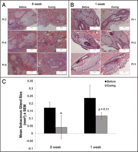 Figure 1 Sebaceous gland size is significantly reduced by isotretinoin at 8 weeks of treatment compared to one week. Hematoxylin and eosin sections of skin biopsies were taken from patients before and at approximately 8 weeks or 1 week of isotretinoin treatment. (A) A total of 16 sections at baseline and 12 sections at 8 weeks of treatment were taken from 8 patients and analyzed using image analysis software. The mean area (±SEM) of sebaceous glands in the baseline samples was 0.17 ± 0.04 mm2 compared to 0.04 ± 0.07 mm2 in the 8-week samples; a four-fold reduction in size (p = 0.009). (B) A total of 17 sections at baseline and 19 sections at 1 week of treatment were taken from six patients and analyzed using image analysis software. In contrast to 8 weeks of isotretinoin treatment, the mean area (±SEM) of sebaceous glands in the 1-week baseline samples was 0.23 ± 0.09 mm2 compared to 0.12 ± 0.02 mm2 after 1 week of treatment, which was not significant using a paired t-test (p = 0.16). Representative images from three patients at each time point are shown at original magnification of 100x. Magnification bars = 250 µm. *Initial publication: Journal of Investigative Dermatology advance online publication, 6 November 2008; doi:10.1038/jid.2008.338.