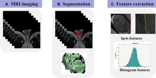 Figure 2 Flowchart of feature extraction. (A) All patients underwent preoperative magnetic resonance imaging. (B) Testicular lesions were delineated by stacking regions of interest (ROI) slice-by-slice on the transverse T2-weighted images. (C) The Ipris and histogram features were extracted from T2WI by Python software and IF software, respectively.