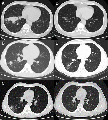 Figure 1 Paired axial unenhanced CT scans of the three patients performed at admission and at the last follow-up (A–C) Lung CT scans taken at admission, showing similar observations for the three patients: nodules, patches, cavities, and ground-glass or sheet-like high-density opacities. (D–F) Corresponding CT scans taken at the last follow-up showing a significant reduction in the extent of ground-glass opacification and residual bronchiectasis in the three patients.