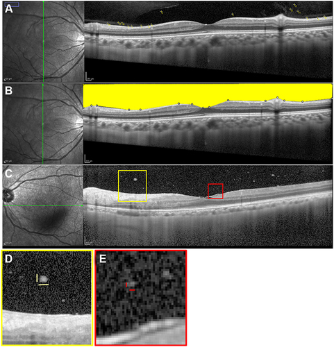 Figure 1 Measurement of the number of vitreous particles, vitreous particle density, and length of the largest and smallest vitreous particles on optical coherence tomography (OCT). On the vertical OCT scan image (A), 13 vitreous hyperreflective particles were counted manually in the vitreous space observed using OCT, with ImageJ software. Subsequently, on the same vertical OCT scan image (B), the vitreous area shown in yellow was defined as the space lying between the vitreous top and the internal limiting membrane, observed OCT. On another horizontal OCT scan image (C), the largest cell (vertical x horizontal shown as yellow bar: 64×138 µm) was shown in the yellow box (D) and the smallest cell (vertical x horizontal shown as red bar: 20×36 µm) in the red box (E). The longest length of largest and smallest cells are 138µm (D) and 36 µm (E), respectively.