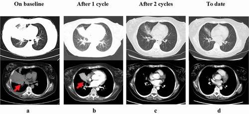 Figure 3. CT scan prior to initiation of PD-1 inhibitor treatment (29 Oct 2019) (a), one cycle after PD-1 inhibitor treatment (11 Nov 2019) (b), and two cycles after treatment initiation (9 Dec 2019) (c). The patient remains in CR by maintenance therapy with PD-1 inhibitor to date (d)
