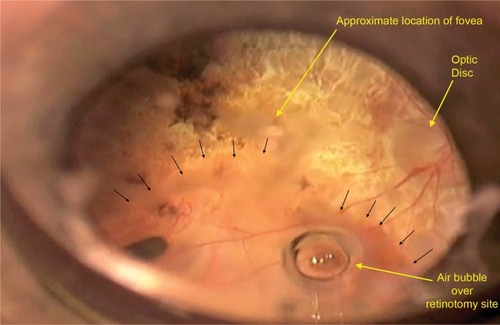 Figure 1 Appearance of subretinal bleb containing palucorcel injection immediately after completion of the injection of the cellular product at the time of surgery.