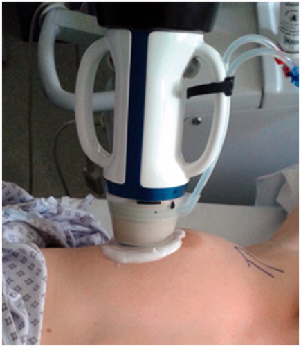 Figure 1. High intensity focused ultrasound (HIFU) treatment of breast fibroadenoma using the Echopulse device (Theraclion Ltd., Malakoff, France).