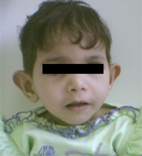 Figure 2 Facial features of an 8-year-old girl with Sanjad–Sakati syndrome.
