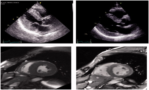 Figure 2. Echocardiogram and MRI of a subject with hereditary ATTR cardiomyopathy: Top (Echocardiogram): IVS decreased from 1.8 cm (left) at baseline to 1.4 cm at 2.5 years (right). Bottom (MRI): LVM decreased from 331 grams at baseline (left) to 149 grams at 3 years (right).