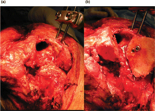 Figure 2. a) Peroperative view showing severe destruction of both condyles. b) The femoral pins are placed medially, so as not interfere with the preparation of the medullary canal. Two hemi-femoral head allografts were required to reconstruct the femoral condyles. [Color version available online.]