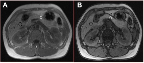 Figure 1 T1-weighted in-phase (A) and out-of-phase (B) axial images in 44-year old female who did not have post-ERCP pancreatitis.