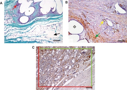 Figure 4A–C Histological quantification.Notes: (A) In sections stained with Verhoeff’s hematoxylin (Merck KGaA, Darmstadt, Germany) and green trichrome (DiaPath, Martinengo, Italy), the area fraction of collagen (stained green), adipose tissue, and granulomatous infiltrates (red arrow) was quantified. The area occupied by dissolved tissue scaffolds (asterisk) or by artificial microcracks (black arrow) was excluded from the reference area. Magnification 100×, scale bar 200 μm. (B) For all area quantifications, stereological point grids were superimposed on histological micrographs, points striking the structures of interest within the total area were counted, and the sum of these points was multiplied by the area corresponding to each point (marked “a” within the square). This is illustrated in an immunohistochemical section showing α-smooth-muscle actin-positive vascular smooth-muscle cells (yellow arrow) and myofibroblasts (green arrow). Magnification 200×, scale bar 100 μm. (C) Counting CD31-positive microvessel profiles per section area using projection of an unbiased counting frame consisting of two admittance borders (green) and two forbidden borders (red). Magnification 200×, scale bar 100 μm. Counterstaining Gill’s hematoxylin (Dr Kulich Pharma, Otrokovice, Czech Republic) (B, C).