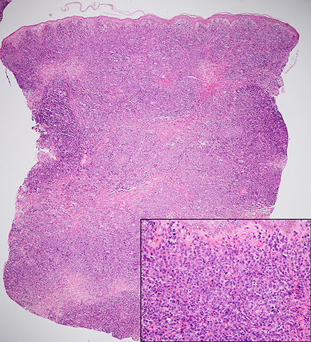 Figure 3 Histopathology from the new lesion on the left leg shows dense, diffuse atypical large mononuclear cell infiltration in the entire dermis (H&E x40); monomorphous atypical large lymphocytes of centroblastic morphology with frequent mitotic figures (inset, x400).