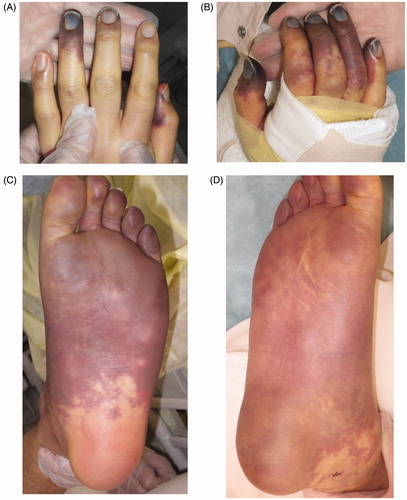 Figure 1. The conditions at day 5 of hospitalization are shown. The purpura had expanded to both hands and feet. (A) Left hand, (B) right hand, (C) left foot, (D) right foot.