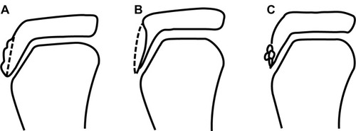 Figure 1 The severity of Osgood–Schlatter disease in the epiphyseal stage on radiographic findings. (A) Grade I, upheaval or slight elevation of the tibial tuberosity; (B) grade II, radiolucency of the tibial tuberosity; (C) grade III, fragmentation of the tibial tuberosity.