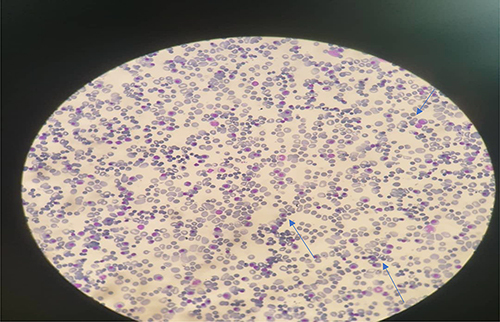 Figure 1 Peripheral morphology showed normoblasts and megaloblastic features.