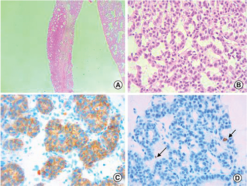 Figure 3. Histological features of the hepatic VIPoma.(A) Glandular architecture of the tumor (Hematoxylin-eosin x100). (B) Tumor cells are monotonous and display round nuclei and moderate amounts of eosinophilic cytoplasm. Nuclei show a characteristic stippled (“salt and pepper”) chromatin pattern with inconspicuous nucleoli (Hematoxylin-eosin x400). (C) The tumor is diffusely and strongly positive for CD56 immunostaining (×400). (D) The proliferation marker Ki-67 highlights 2% of the neoplastic cells (arrow), consistent with a low proliferation index (×400).