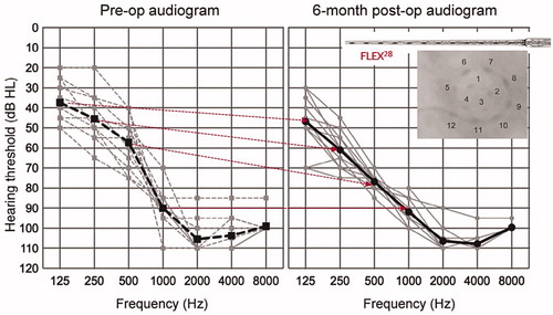 Figure 51. Average air-conduction hearing thresholds. The dashed and solid lines indicate pre-op and six months post-op, respectively. Grey and black lines show the individual and mean results [Citation43]. Reproduced by permission of Taylor and Francis Group.